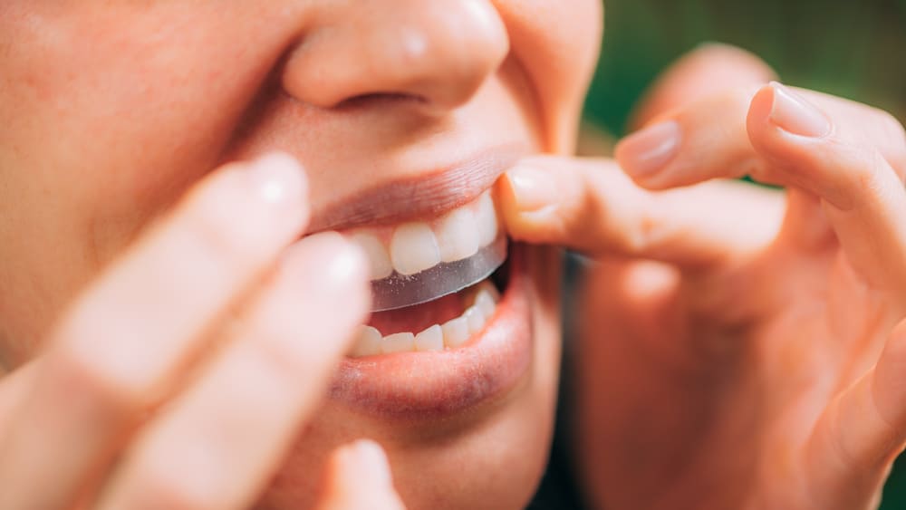 How Long Will Your Teeth Whitening Last?