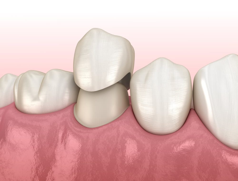 root canal required for a crown