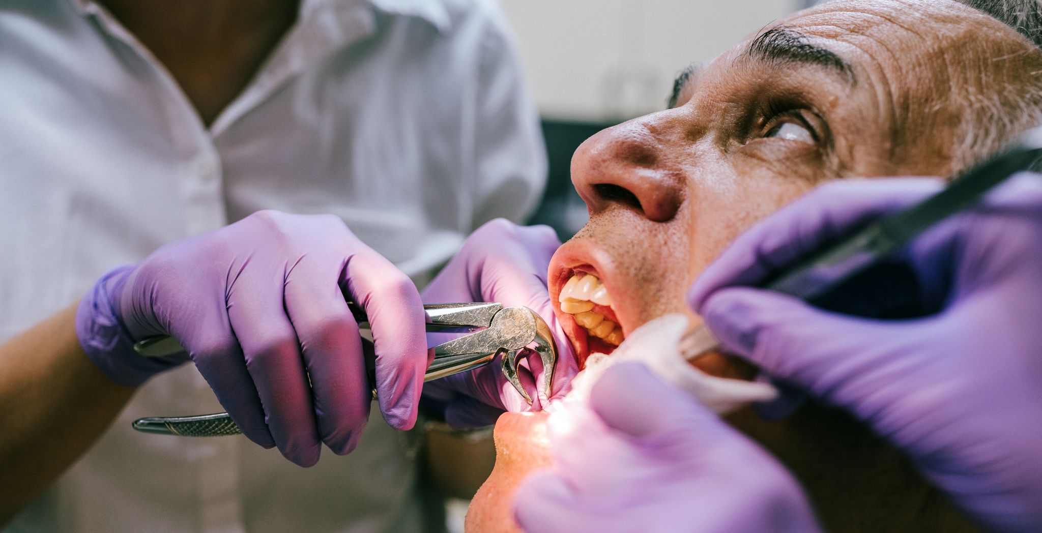 Stage of Tooth Extraction
