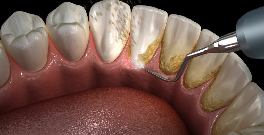 Removing dental plaque, Dental plaque removal, How to remove plaque from teeth, Natural ways to remove plaque, Plaque prevention tips, Tooth cleaning techniques, Dental hygiene routine, Brushing and flossing for plaque control, Professional teeth cleaning, Tartar and plaque removal, Healthy teeth maintenance, Oral care for plaque-free smile, Preventing gum disease from plaque